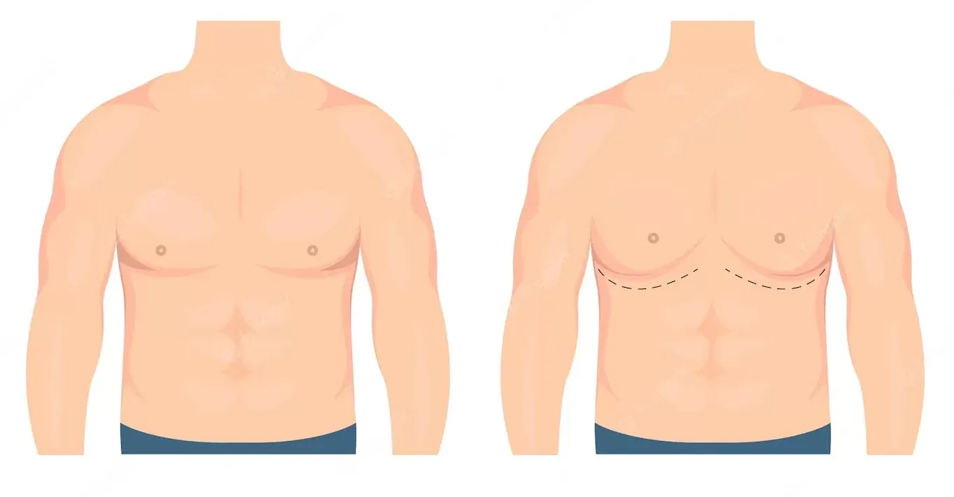 Recomendações para a Cirurgia de Ginecomastia