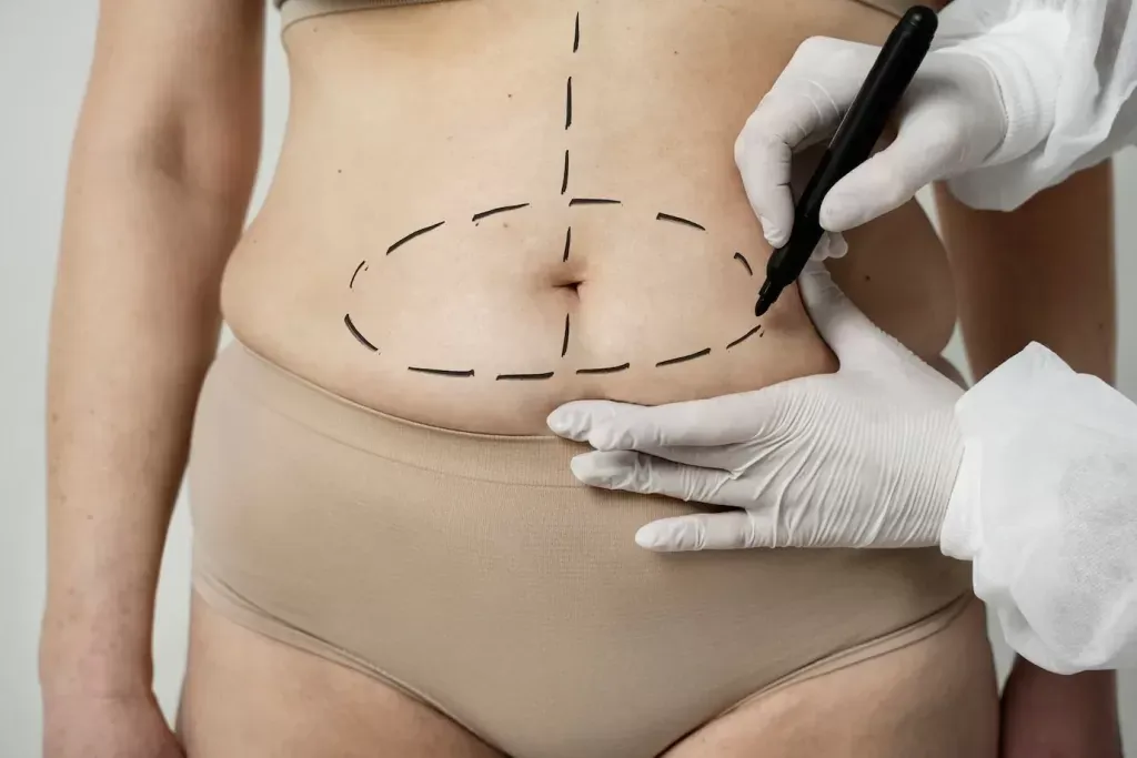 Lipo HD e seus resultados