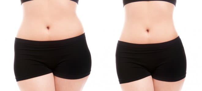 Hidrolipo: alternativa à Lipoaspiração para remodelar o contorno corporal