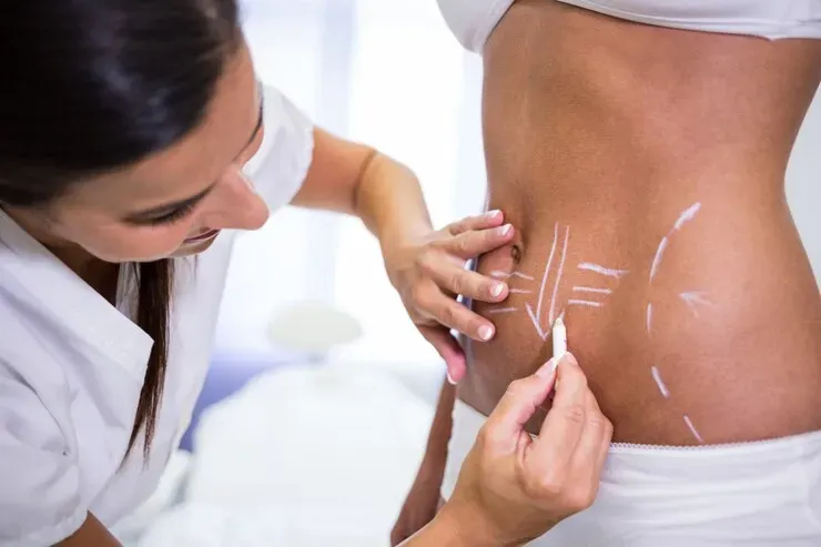 Mini Abdominoplastia: Quanto Custa, Como é Feita e Recuperação