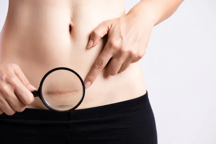 Cuidados com a Cicatriz na Cirurgia Plástica