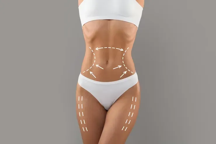 Tudo o que você precisa saber sobre Lipoescultura
