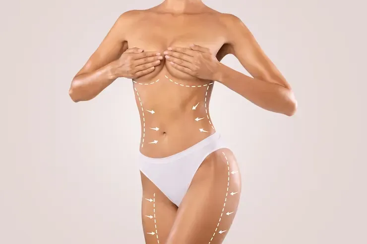 Tudo o que você precisa saber sobre Lipoescultura