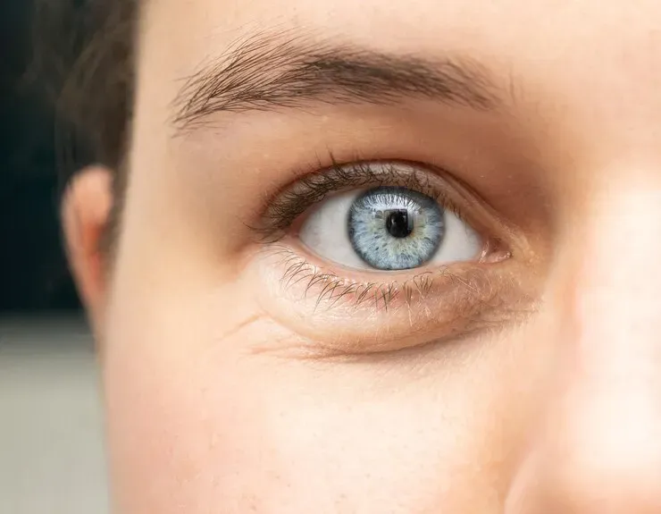 Renovando seu olhar com a Blefaroplastia Inferior
