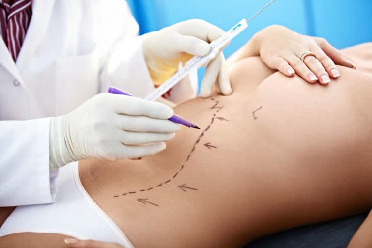 Em quais áreas do corpo a Lipoaspiração pode ser feita?