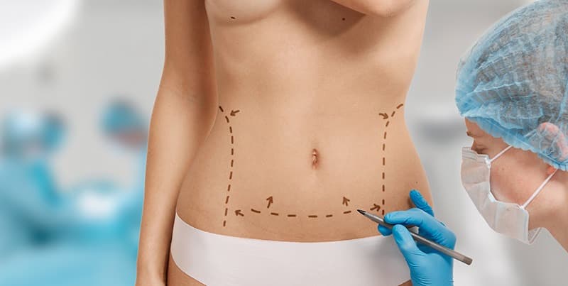 Abdominoplastia pode ser associada com outras cirurgias?