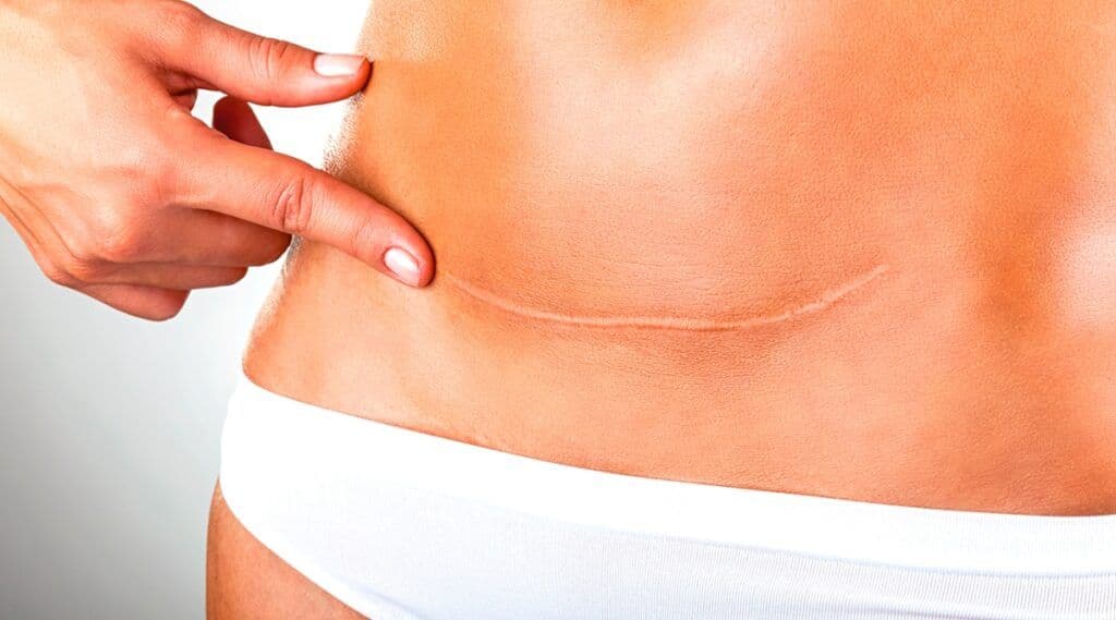 Curiosidades acerca da Correção de Cicatrizes