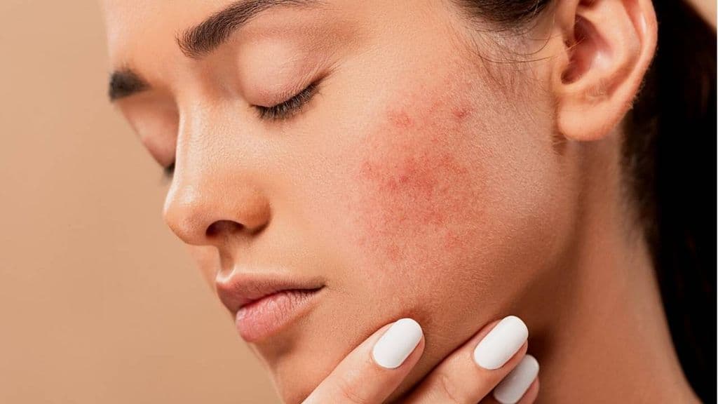 Cicatriz-de-Acne