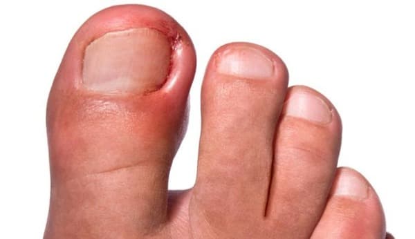 Saiba mais sobre Cirurgia de Unha Encravada