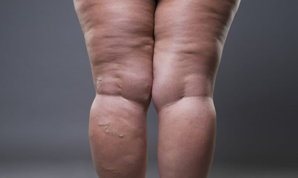 Lipedema: o que é, quais sintomas e tratamento?