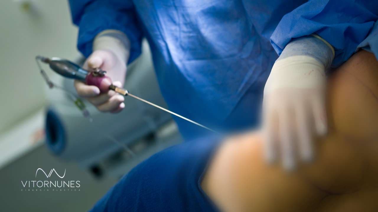 Você conhece os tipos de Lipoaspiração?