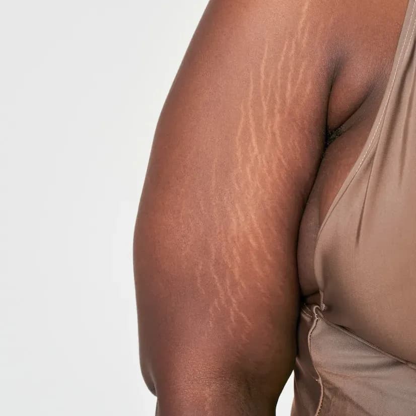 Existe tratamento para camuflar as estrias? Saiba mais