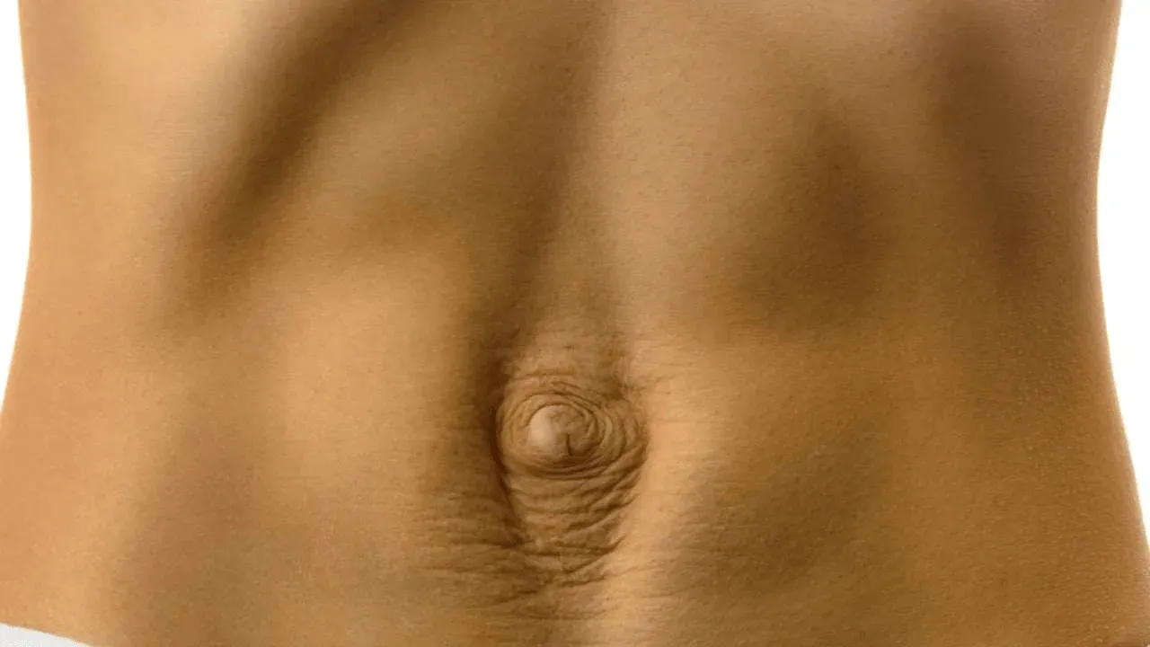 Saiba tudo sobre Diástase Abdominal