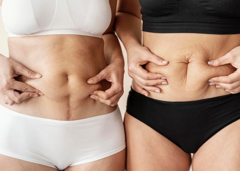 Saiba tudo sobre Diástase Abdominal