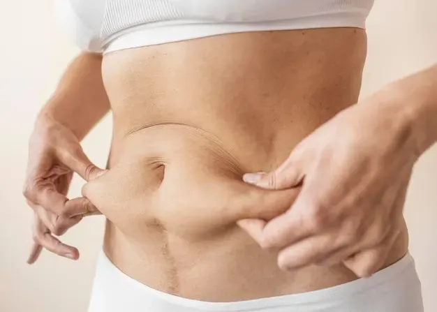 Como fica o umbigo após a abdominoplastia