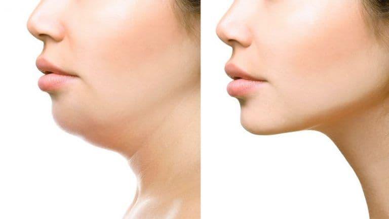 Lifting de Papada ou Cervicoplastia: saiba mais!!!