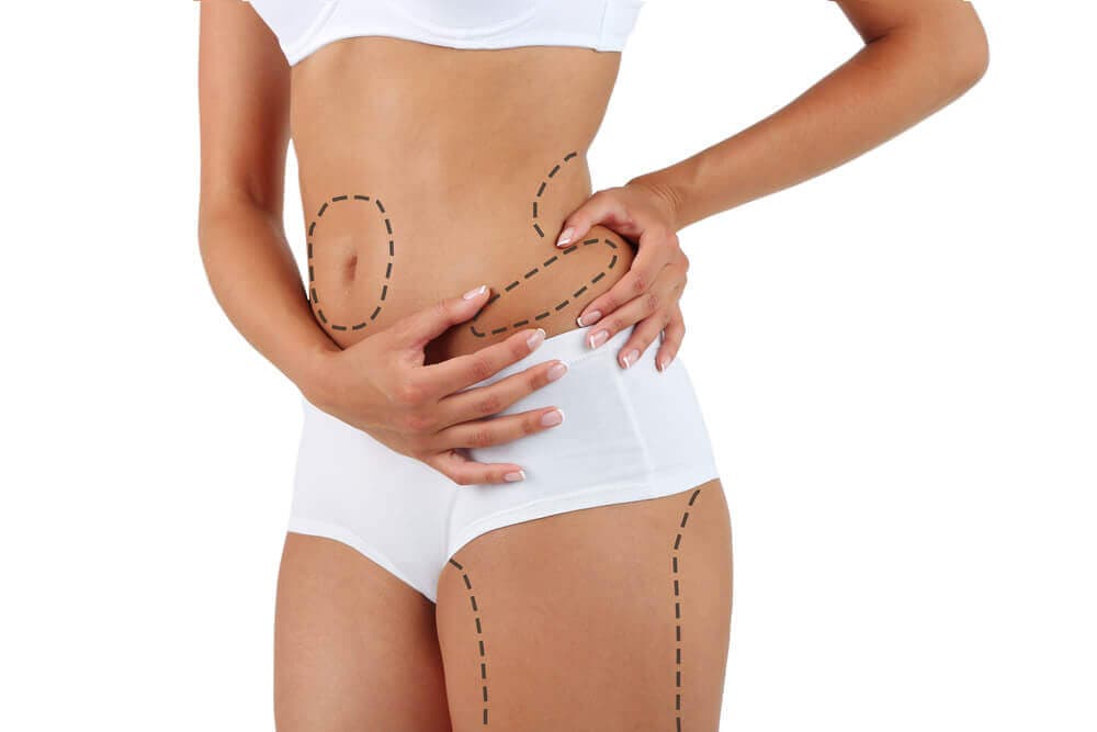 É comum necessitar do retoque após Lipoaspiração?
