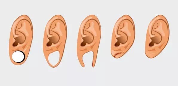 Lobuloplastia: cirurgia plástica para orelha rasgada