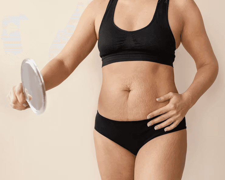 Onfaloplastia: cirurgia para correção do umbigo