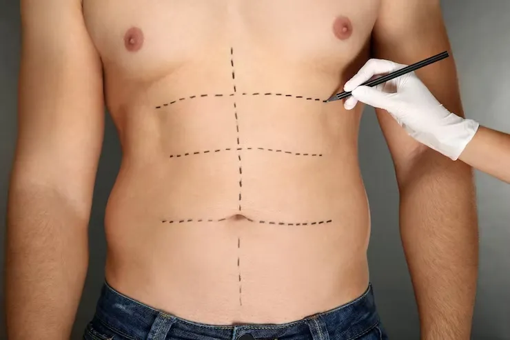 O que é a Abdominoplastia Masculina?