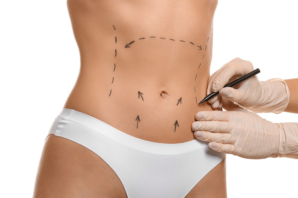 Abdominoplastia_saiba_tudo_sobre-a-cirurgia_do_Abdomen_1