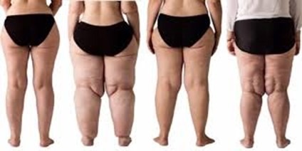 Lipedema: o que é, quais sintomas e tratamento? - Dr. Vitor Nunes