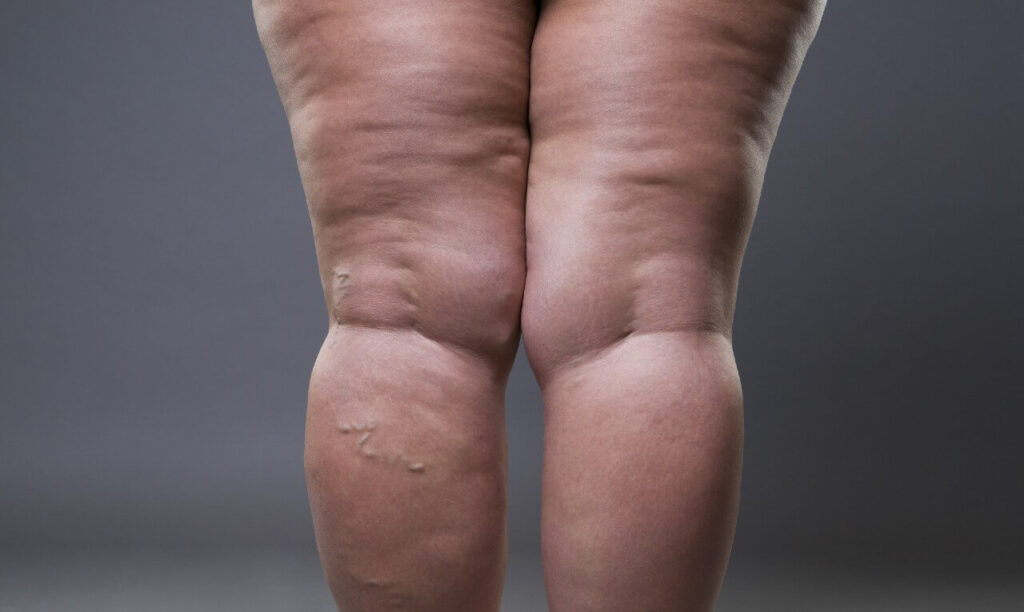 O que é, como diagnosticar e tratar o lipedema, doença prevalente em  mulheres