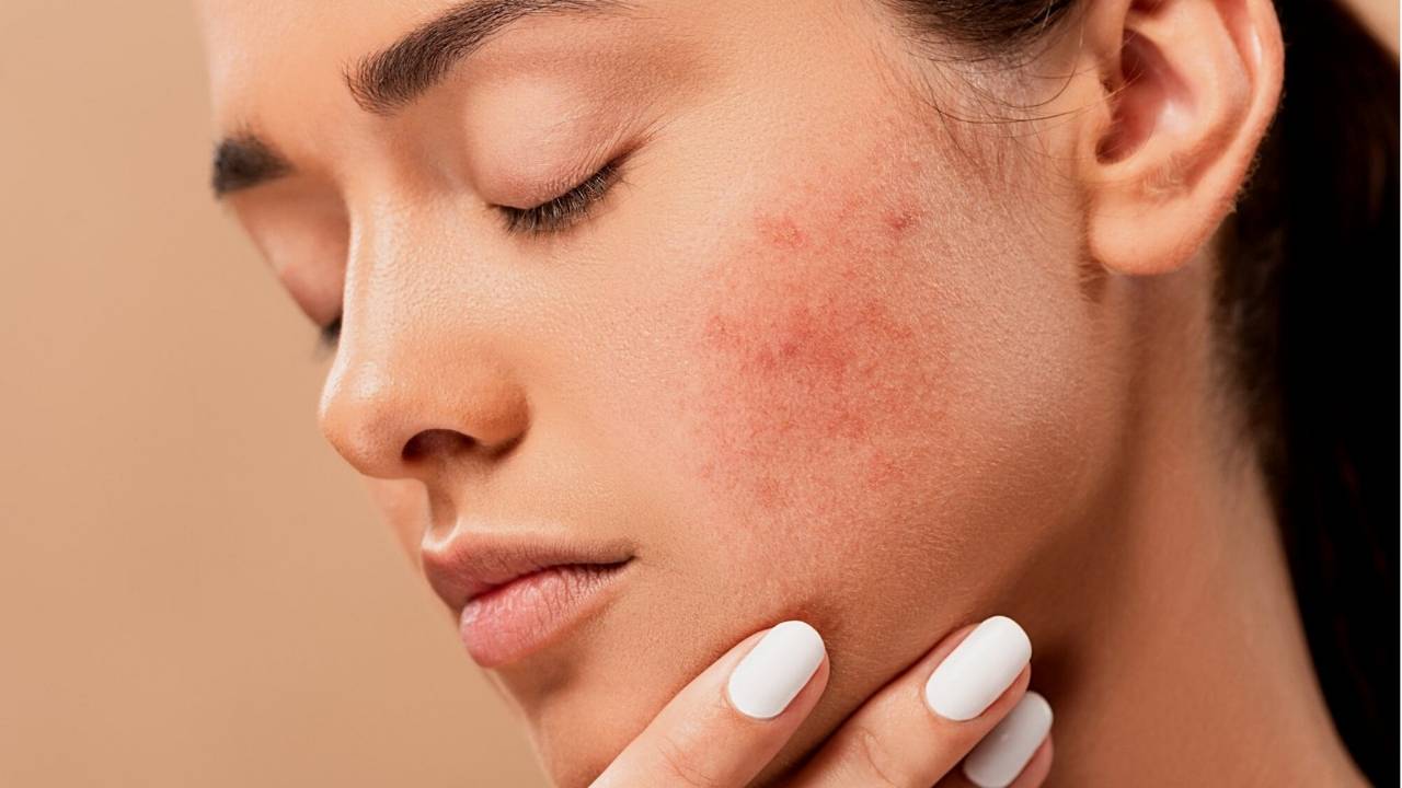 Cicatriz-de-Acne