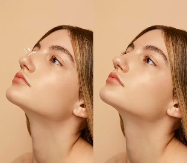 Rinoplastia Rinoplastia
