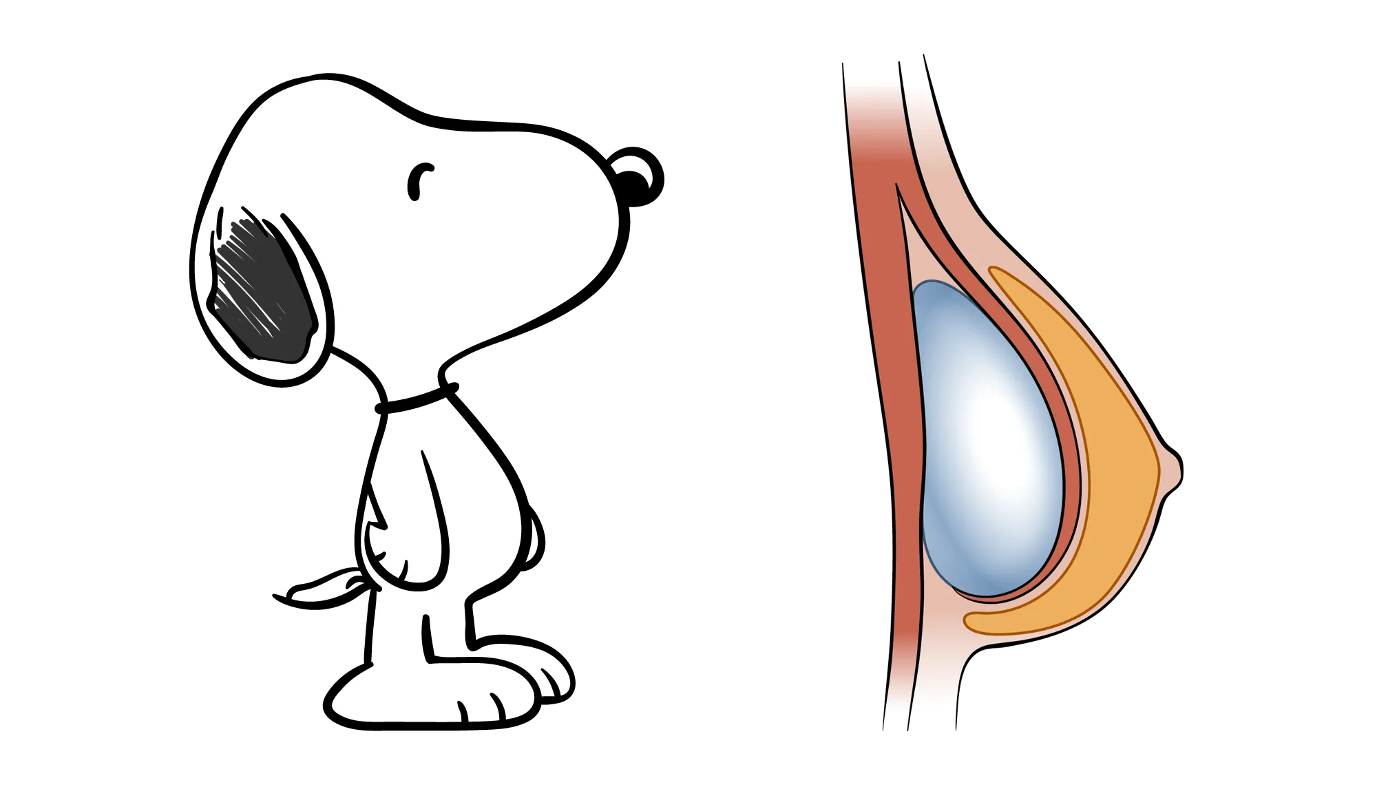 "Snoopy" na Cirurgia Mamária